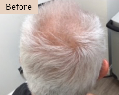 injections for hair loss treatment - before and after results